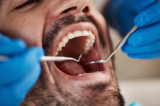 Best Emergency Wisdom Teeth Removal in Sonoma State University, CA