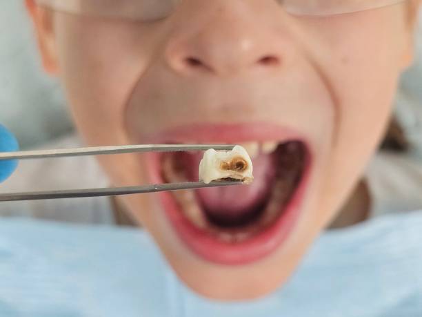 Best Same-Day Emergency Dental Services in Sonoma State University, CA